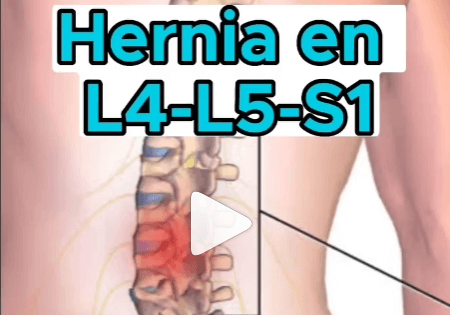 Hernia en L4-L5-S1 Dolor de espalda